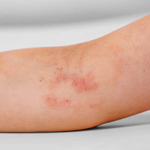 Atopic Dermatitis